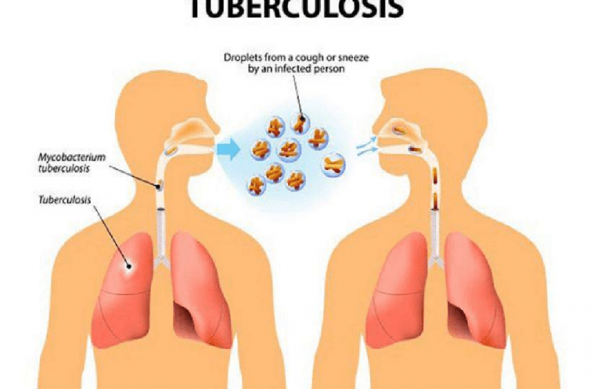 टीबी (Tuberculosi) TB
